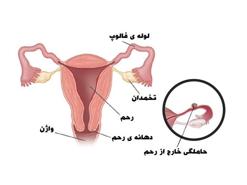 حاملگی خارج از رحم