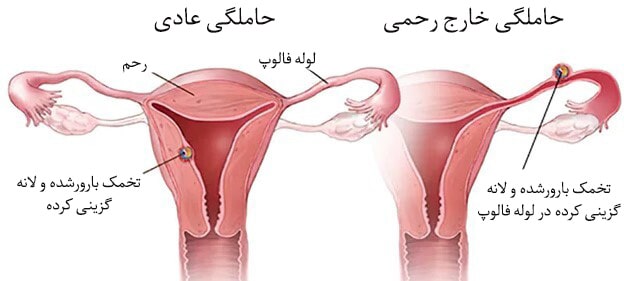 بارداری خارج از رحم